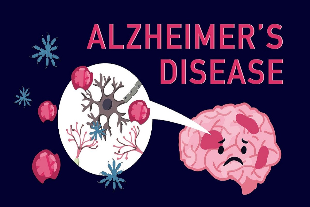  भूलने की बीमारी और चिड़चिड़ापन अल्जाइमर का हो सकता है संकेत, जानें इसके कारण और लक्षणों के बारे में