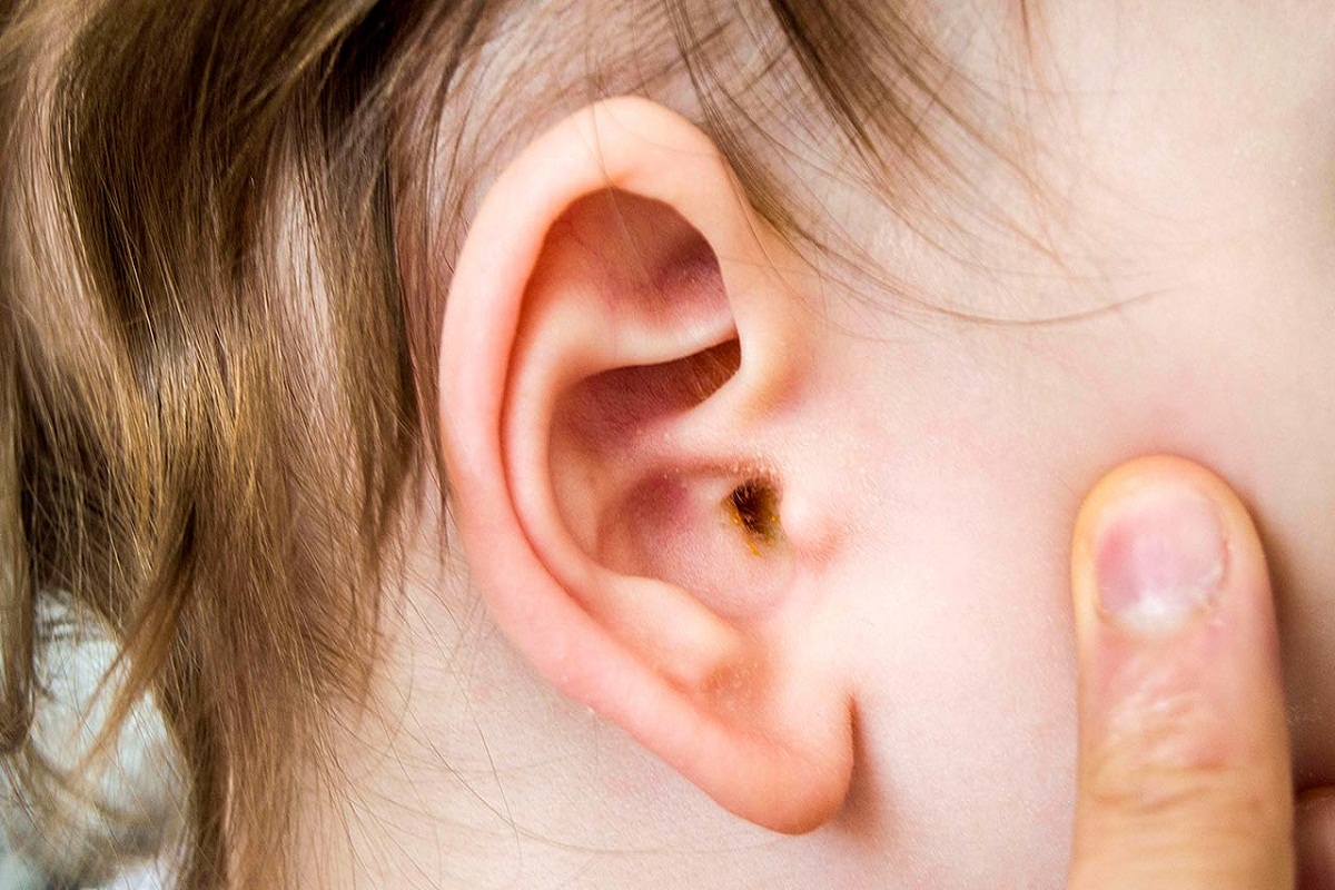 Home Remedies To Get Rid Of Ear Discharge Ear Discharge Home Remedies कान बहने की समस्या को 8508