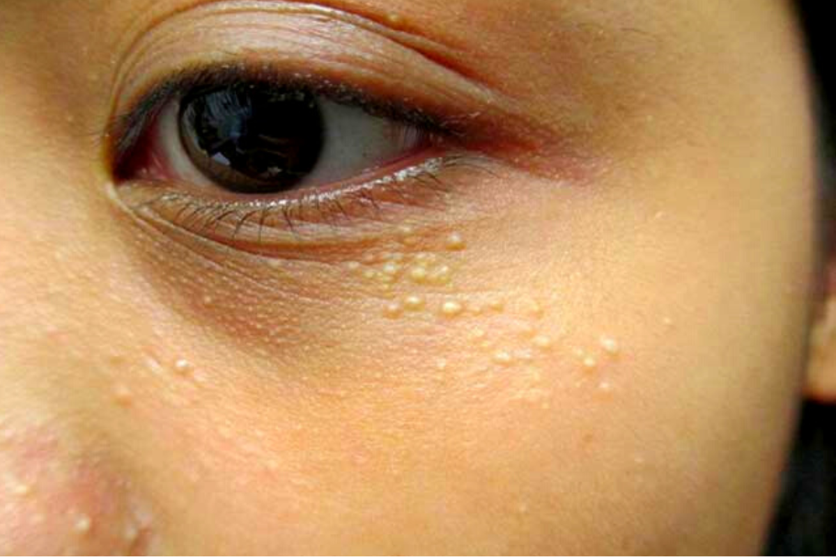 small-white-pimples-under-eyes-causes-and-home-remedies-causes-and