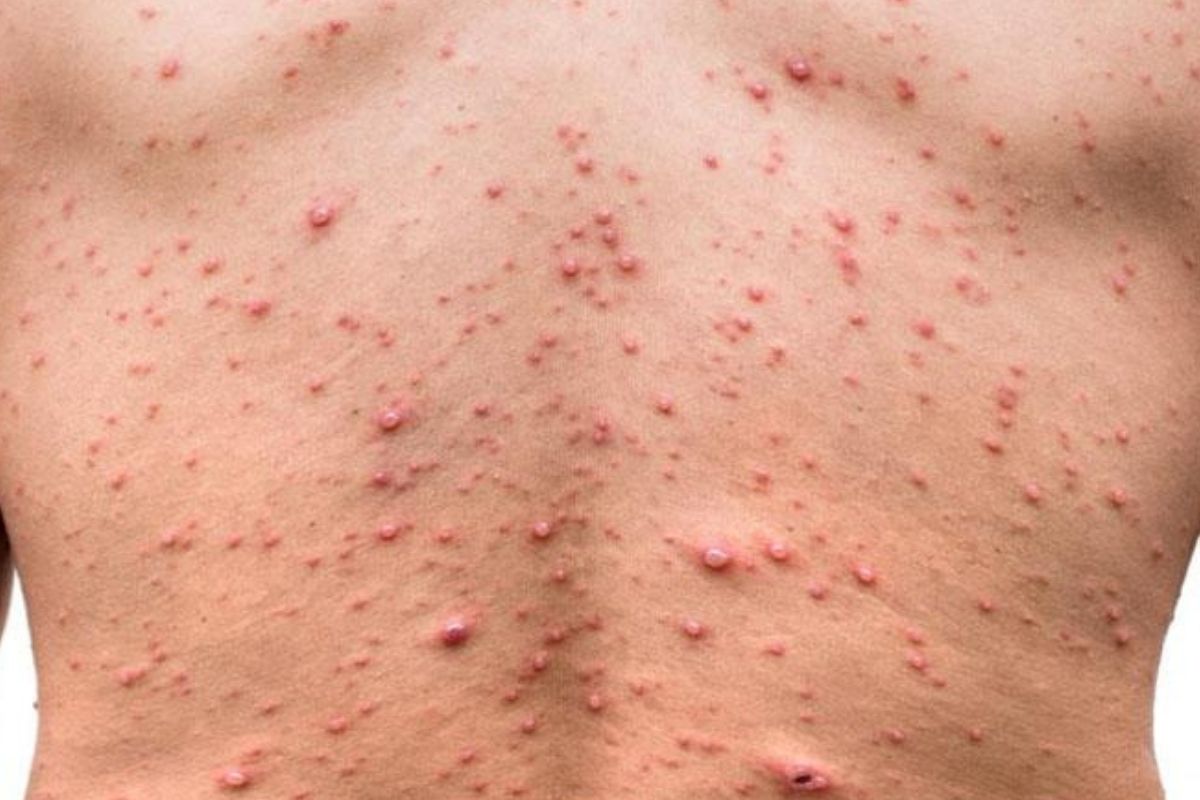 monkeypox disease danger for 4 weeks