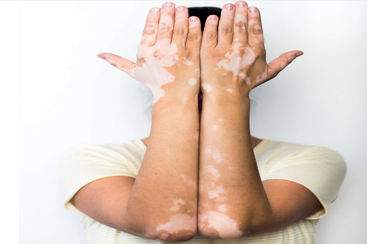 Vitiligo: क्या छूने से भी हो सकती है सफ़ेद दाग की समस्या, जाने  इसके लक्षण और बचाव के इन तरीकों के बारे में