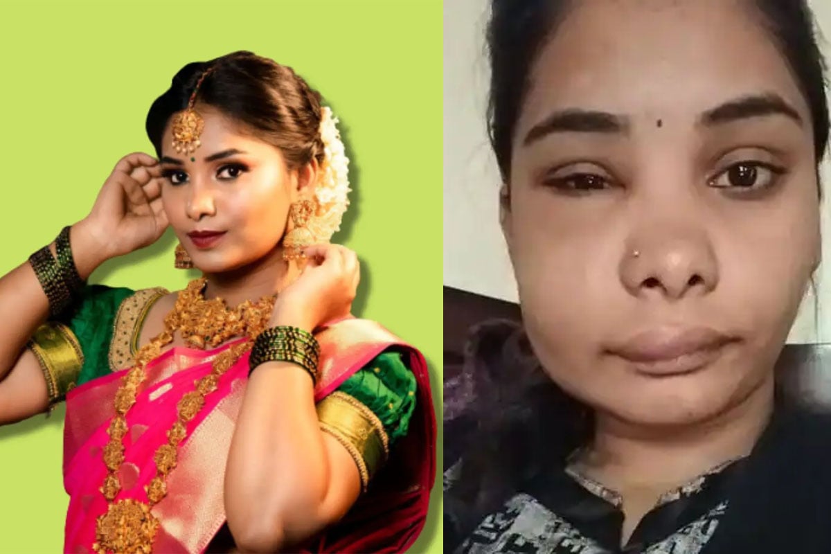 गलत सर्जरी ने बिगाड़ा कन्नड़ एक्ट्रेस Swathi Sathish का चेहरा, घर से निकलना हुआ मुश्किल