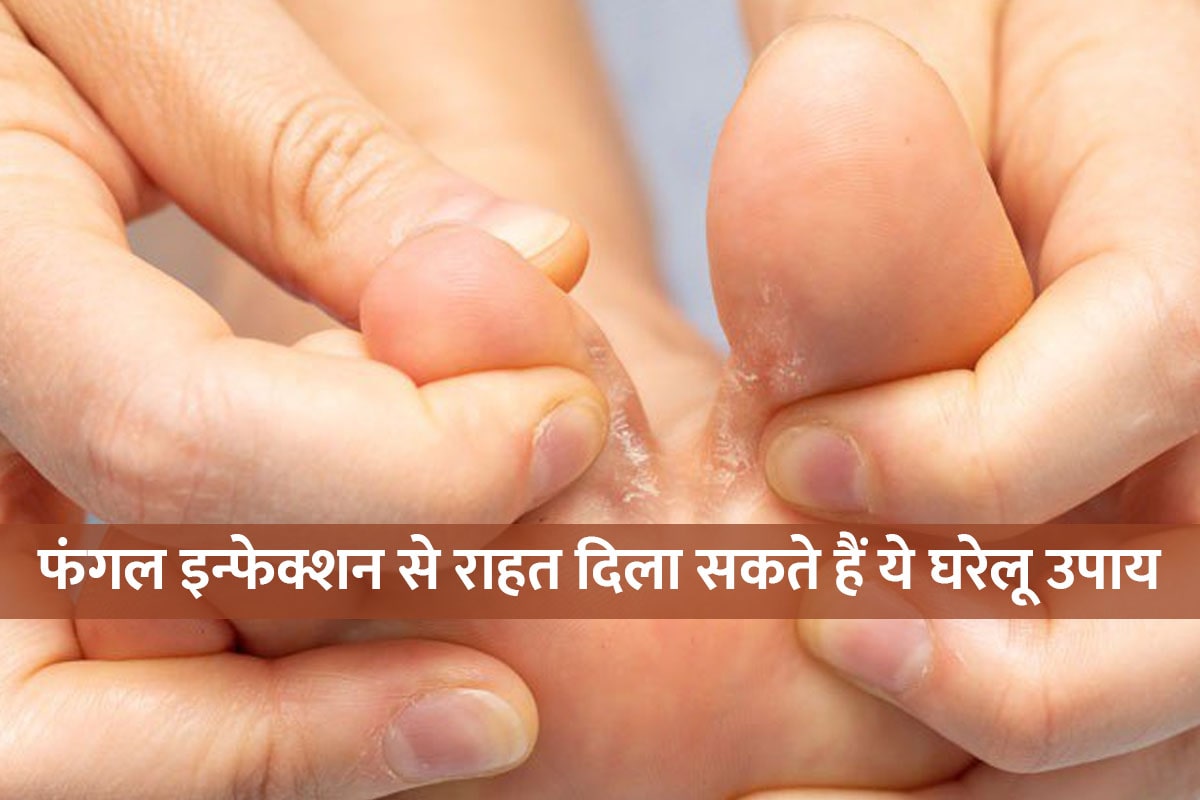 Mansoon, Fungal Infection, home remedies, Mansoon Tips, Home Remedies for Fungal Infection, home remedies for fungal infection on foot, natural home remedies for fungal infection, fungal infection se bachne ke upay, latest health news,