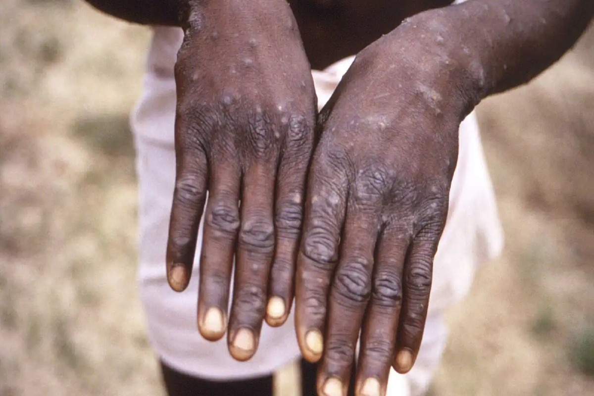 delhi-reports-first-case-of-monkeypox-today-who-has-declared-global-health-emergency.jpg
