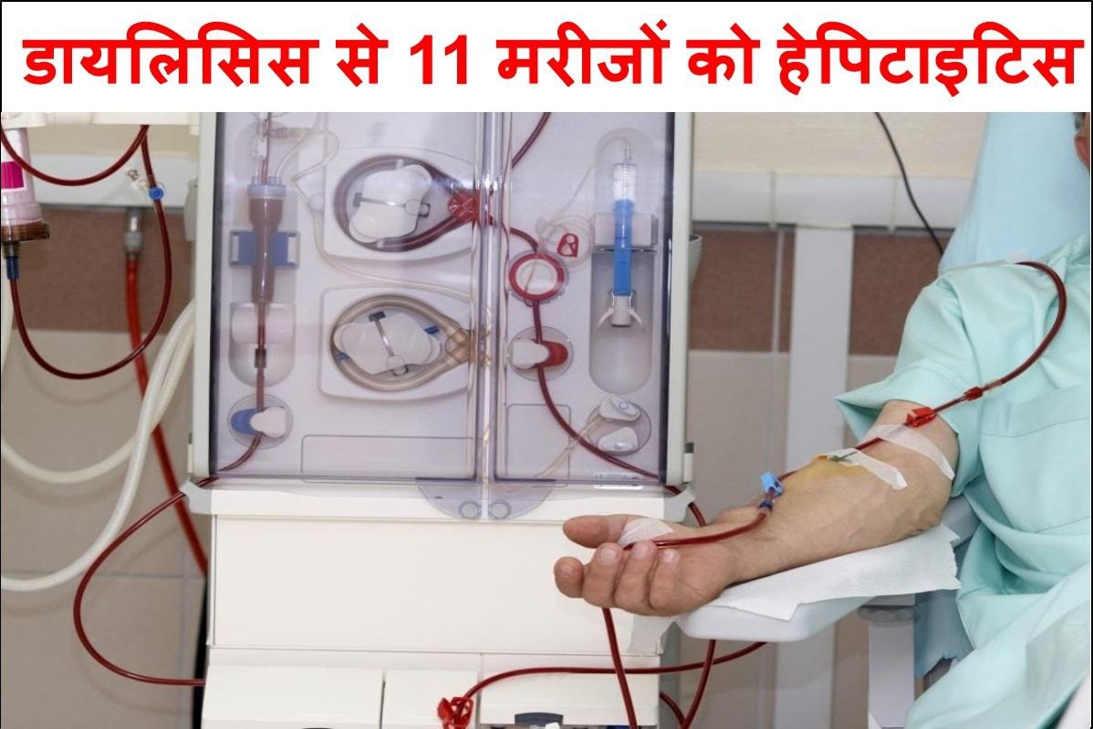 11 Hepatitis patients Found After dialysis at Ursala Hospital in Kanpur