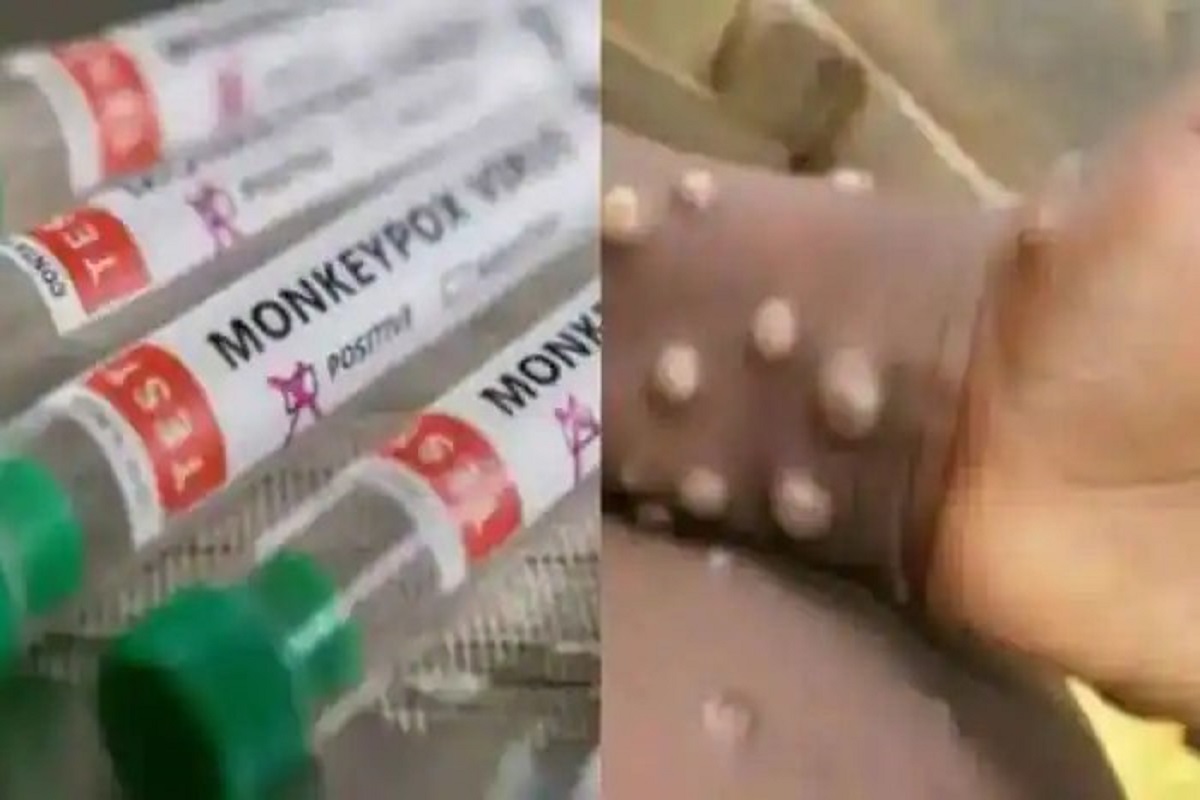 Monkeypox in india: दिल्ली में मिला मंकीपॉक्स का चौथा मरीज, देश में कुल मामले बढ़कर हुए 9