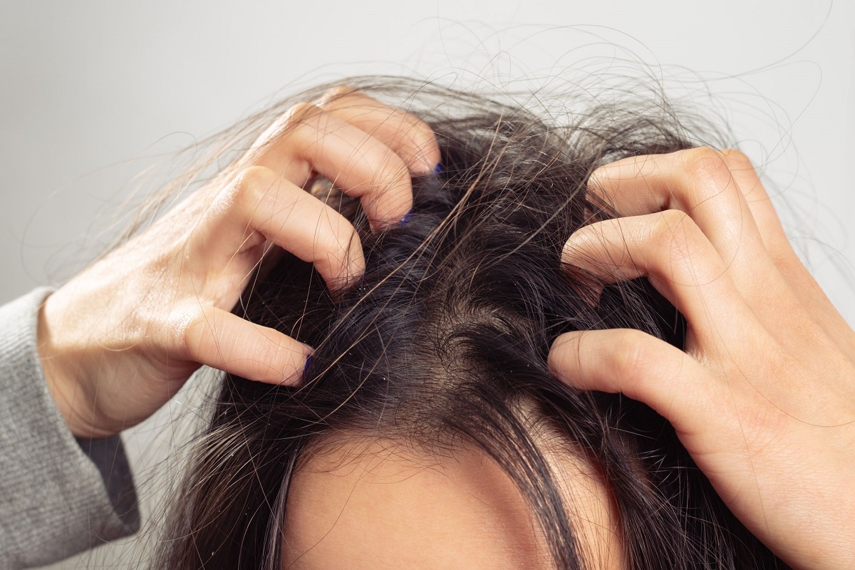 Itchy Scalp Home Remedies: क्या आप भी सिर की खुजली से है परेशान? तो ये घरेलू उपाय दिलाएंगे निजात