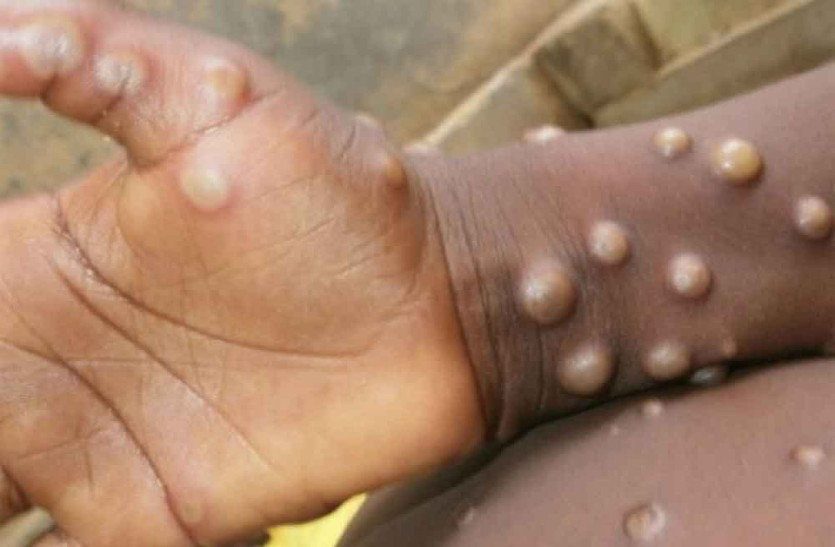 Monkeypox पर एडवाइजरी जारी, बचाव के लिए करने पड़ेंगे ये काम