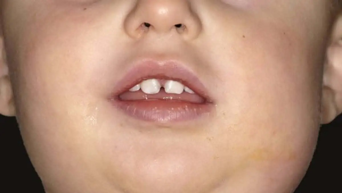 mumps-cases-rise-among-chil.jpg
