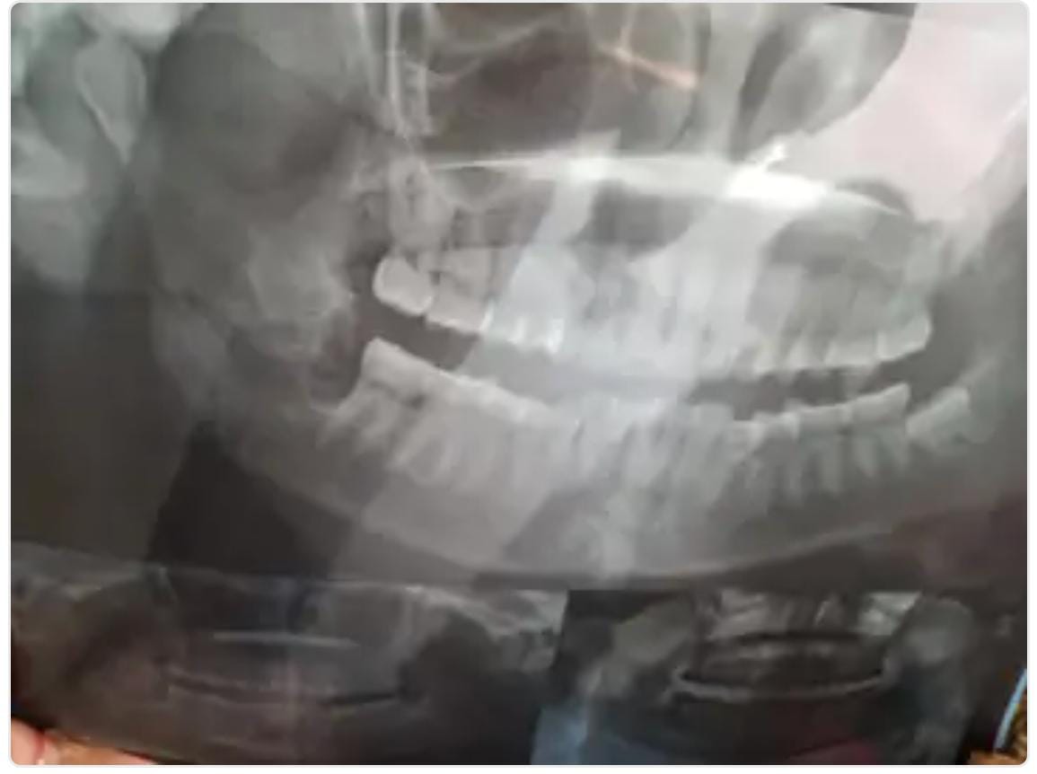 दांत दर्द पर पहुंची जिला अस्पताल, डॉक्टर ने ऐसा चलाया हथौड़ा की महिला का हुआ यह हाल