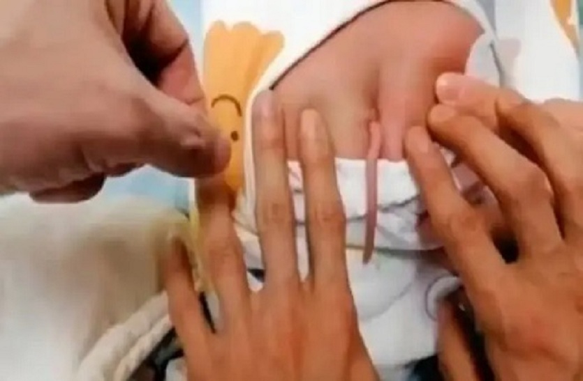 चीन में चार इंच लंबी ‘पूंछ’ के साथ जन्मा बच्चा, डॉक्टर हैरान