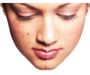 ऎसे हटाए चेहरे के दाग