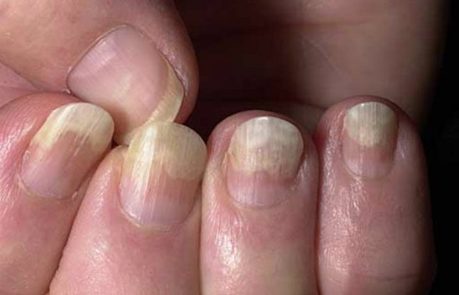 These 10 Signs Of Your Nails Define Your Health - 10 