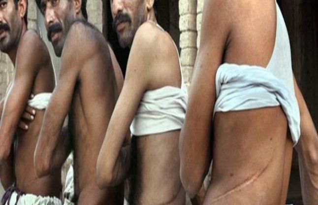 kidney racket किडनी रैकेट केस- दो डॉक्टरों की अग्रिम जमानत याचिका खारिज