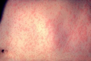 measles चंदौली के दो गावों में खसरा का प्रकोप, एक की मौत