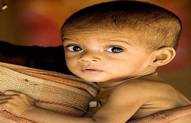 Bhilai city severely malnourished, 60 per cent of कुपोषित बच्चे खोलेंगे आगंनबाड़ी केन्द्रों की पोल