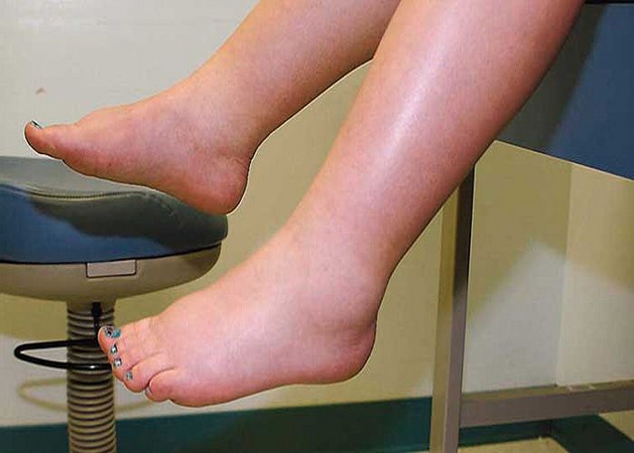tips for reducing swelling शरीर में आ गई है सूजन तो घबरायें नहीं, फॉलो करे ये टिप्स पायें दर्द से निजात