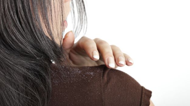 effective tips to get rid of dandruff डैंड्रफ से चाहते हैं छुटकारा तो अपनाएं ये घरेलू उपाय