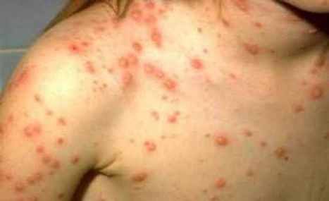 scrub typhus स्क्रब टाइफस को लेकर अलर्ट, इंदौर में शुरू हुआ सर्वे
