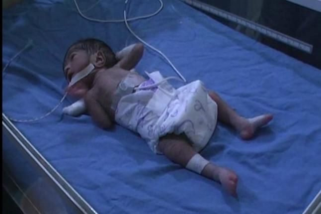 premature baby चमत्कारः 6.5 महीने में पैदा हुआ 700 ग्राम का बच्चा, डॉक्टरों ने ऐसे बचाई जान