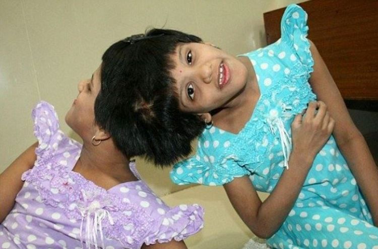 Head Joint Twin Sister Shifted To Children S Home From Hospital 10 स ल म पहल ब र अस पत ल स ब हर न कल स र स ज ड बहन Patrika News