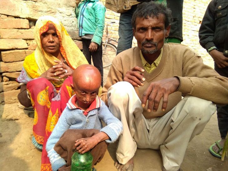 rupesh इस युवक को ऐसी बीमारी, की सर्कस वाले दो लाख में खरीदने को हैं तैयार