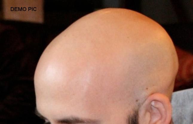 BALD बाल कलर कराने गया और गंजा हो गया, पढ़ें चौंकाने वाली कहानी