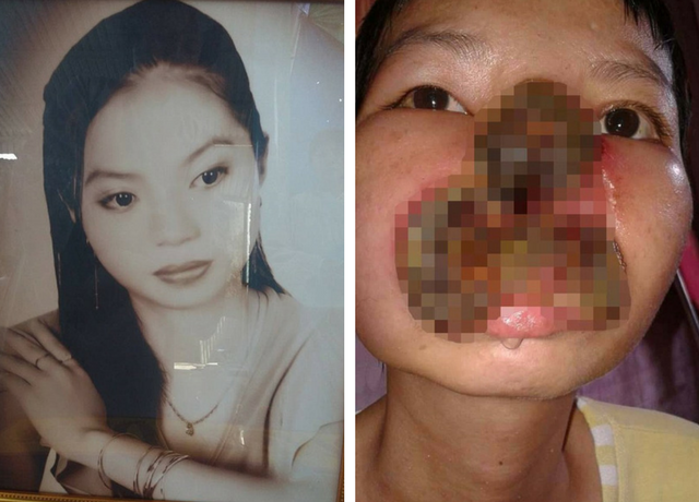 Aspiring actress' face was destroyed by a sinus in बनना चाहती थी एक सफल एक्ट्रेस, लेकिन नाक में हुआ ऐसा इन्फेक्शन कि ज़िन्दगी ही हो गयी खत्म!