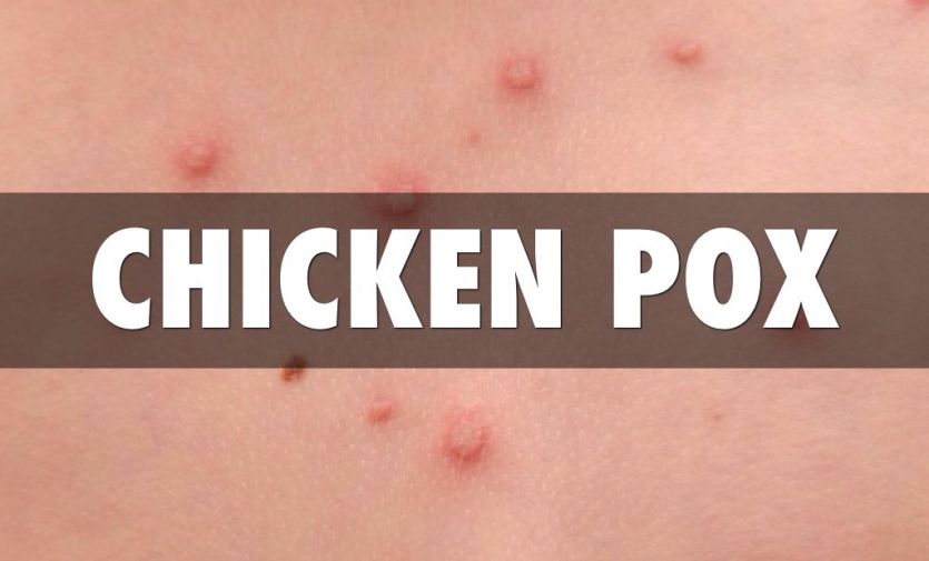 children-death-from-chicken-pox-news-in-hindi