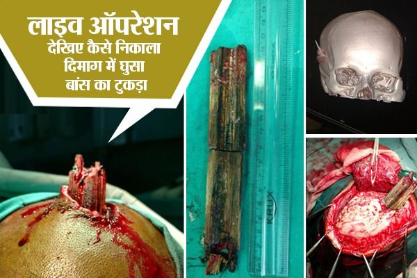 live photo of deadly operation of neurosurgery सिर में घुसा 15 सेंमीटर तक बांस का टुकड़ा, डॉक्टर्स की टीम निकाला