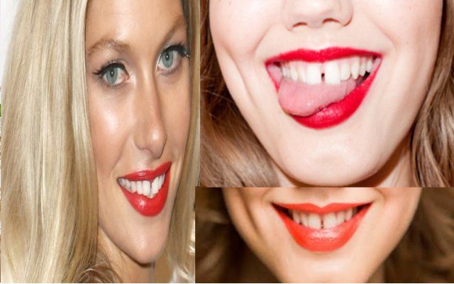 Gap in teeth अगर दांतों में हैं गैप, तो चैक कराएं जबड़ा
