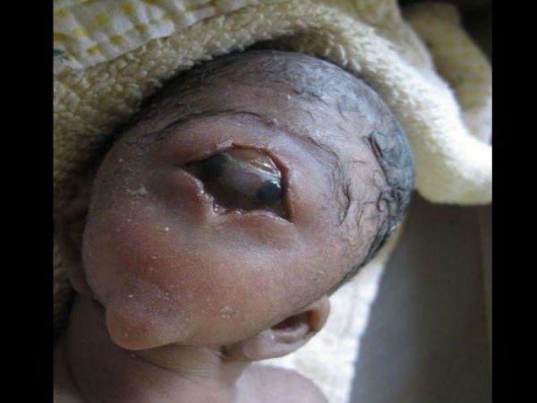 women giving birth to a baby- with 1 eye 1 ear wit दुनिया में पहली बार हुआ ऐसे बच्चे का जन्म जिसे देखकर भाग खड़े हुए लोग, लोगों ने 'इंसान' को बताया 'दैत्य'