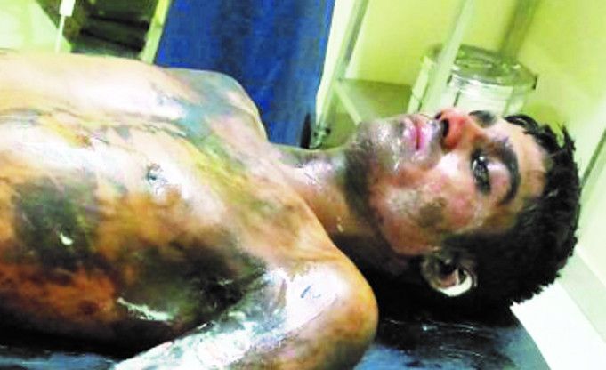 Child accident in plant: Three boars, including op बालको संयंत्र में हादसा : बॉयलर फटने से ऑपरेटर सहित तीन झुलसे, अस्पताल में दाखिल