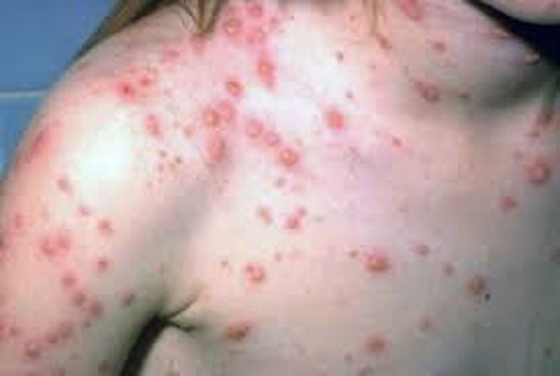 Chickenpox victims strayed for innocent, refusal t चिकनपॉक्स पीडि़त मासूम को लिए भटकते रहे परिजन, भर्ती से इनकार