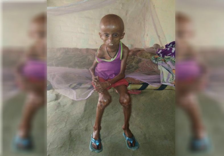 Progeria diseas अमिताभ बच्चन की फिल्म 'पा' का 'ऑरो' उन्हीं के शहर इलाहाबाद में, लाइलाज प्रजोरिया रोग से है ग्रसित