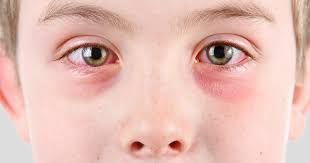 Allergic Conjunctivitis Problems In Eyes Symptoms Causes And Treatment बढ त त पम न क ब च बढ रह ह आ ख स य समस य ए क स कर बच व Patrika News