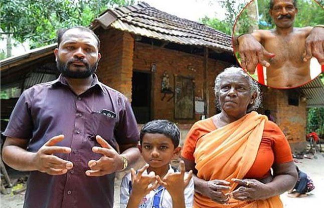 weird fingers इस परिवार के हर सदस्य की होती हैं अजीब उंगलियां