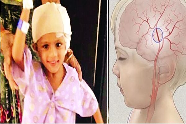 moya moya 3 साल के मासूम को हुई जापानी बिमारी मोया-मोया, धुआं हुई दिमाग की नसें, डॉक्टर्स ने कुछ यूं बचाई जान