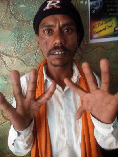 Dhar अंगूठे नही, आधार कार्ड बनवाने के लिए भटक रहा युवक