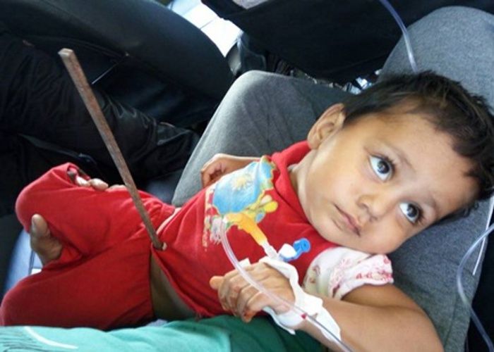 baby girl बच्ची के पेट से आरपार हुआ सरिया, फिर भी बोली- पापा कोई बात नहीं, देखें PHOTO