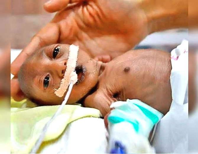 Mother Refused To Breastfeed Baby Girl Born With R नवजात बच्ची का चेहरा देखते ही मां ने छोड़ा लावारिस, लेकिन बच्ची के दादा ने जो किया उसे जानकर आप भावुक हो जाएंगे!