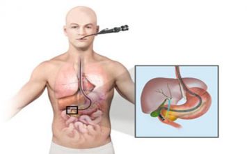 Spyglass Endoscopy Spyglass Endoscopy