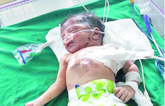 bangalore news झाडिय़ों में मिली नवजात बच्ची की सेहत बिगड़़ी