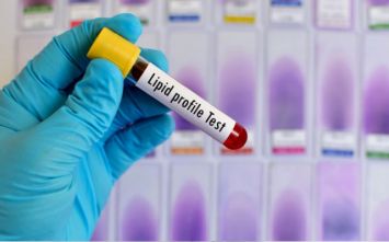 Lipid profile test Lipid profile test