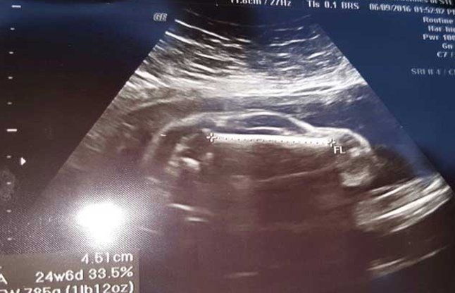 car in womb प्रेग्नेंट बीवी की अल्ट्रासाउंड में नजर आई बच्चे की जगह स्पोर्ट्स कार
