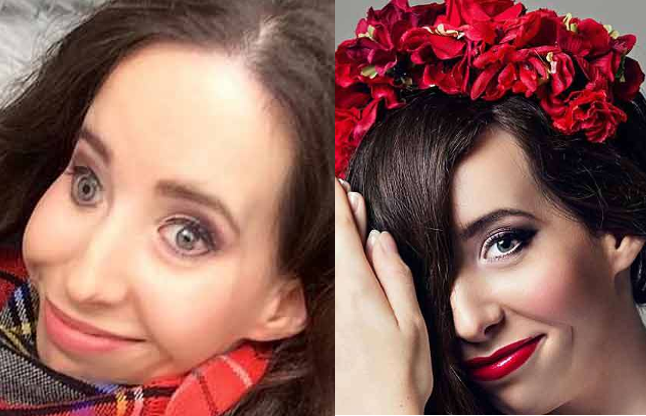 woman with half face आधे चेहरे के साथ पैदा हुई लड़की, अमरीका में सर्जरी के बाद दिखती है ऐसी