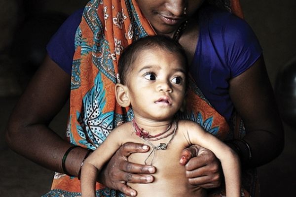 malnutrition आंगनवाड़ियों में खर्च हो रहे हैं करोड़ों, फिर भी MP के बच्चों को नहीं मिल रहा पोषण