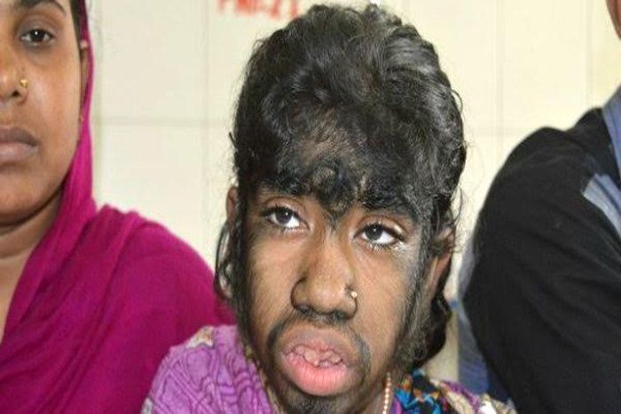 Girl Suffering From Werewolf Syndrome Covered In Hair इ स न र प म लड क बन भ ड य प र शर र पर उग आए ऊन ज स म ट ब ल Patrika News