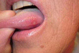 l_Blisters-on-tongue-1463582990_280x183.jpg