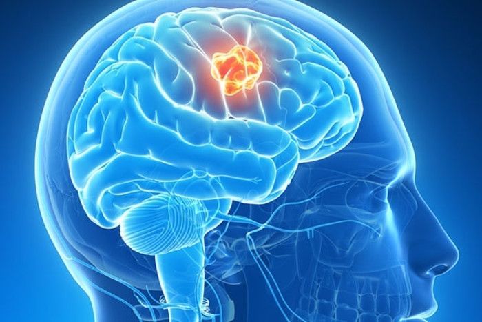 Do You Know Everything About Brain Tumor - ब्रेन ट्यूमर का संकेत, तेज सिरदर्द के साथ नींद टूटना | Patrika News